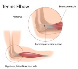 Treatment of Tennis Elbow at The London Shockwave Clinic